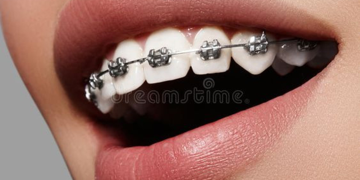 Achieving a Radiant Smile with Orthodontics in Grantham: A Comprehensive Guide