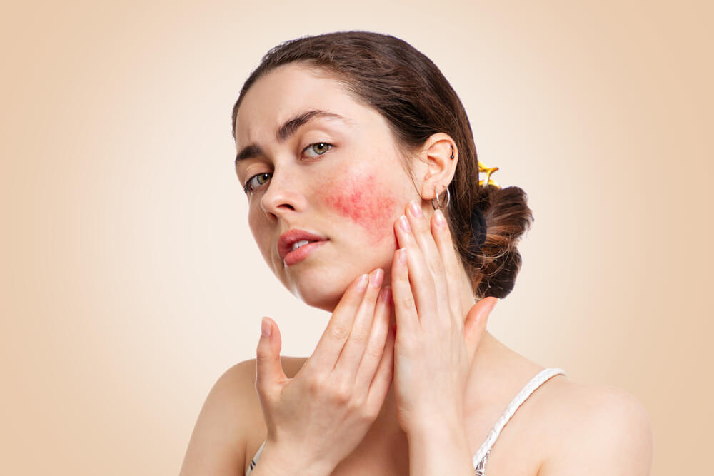 Rosacea: All the Information You Need | Dermaflage