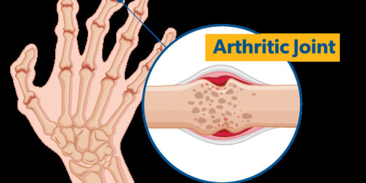 Unveiling a Future Free from Arthritis: A Comprehensive Guide