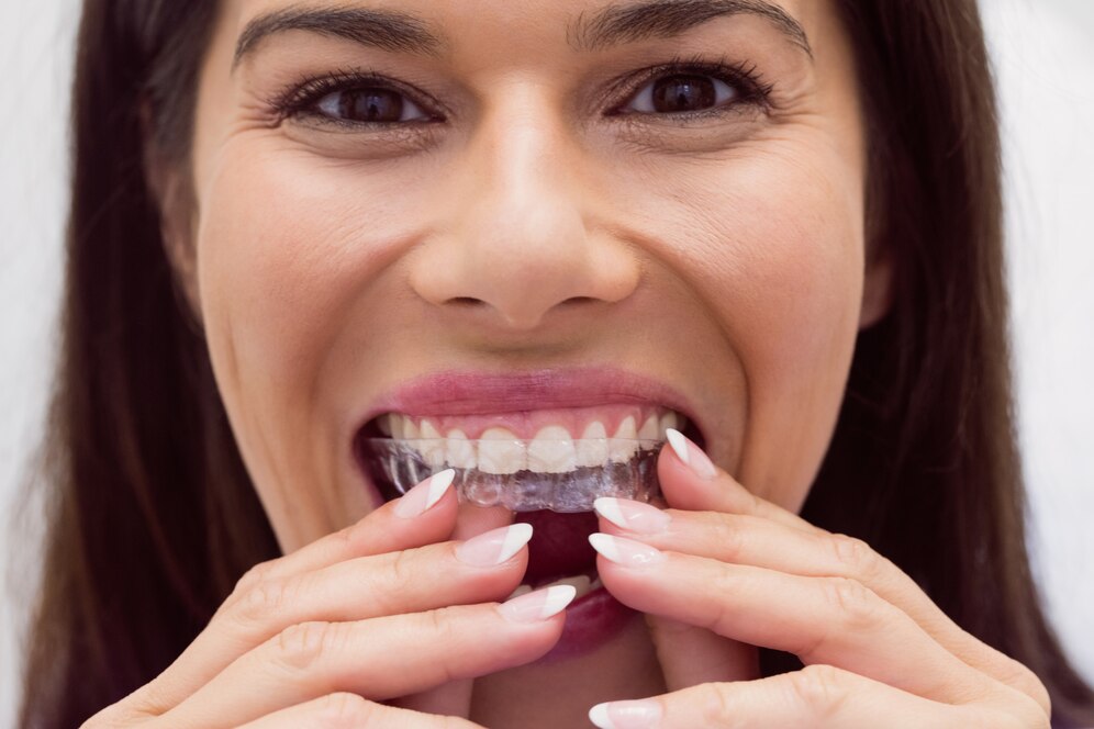 Braces vs. Invisalign in Hamilton: Which Option Works Best for You?