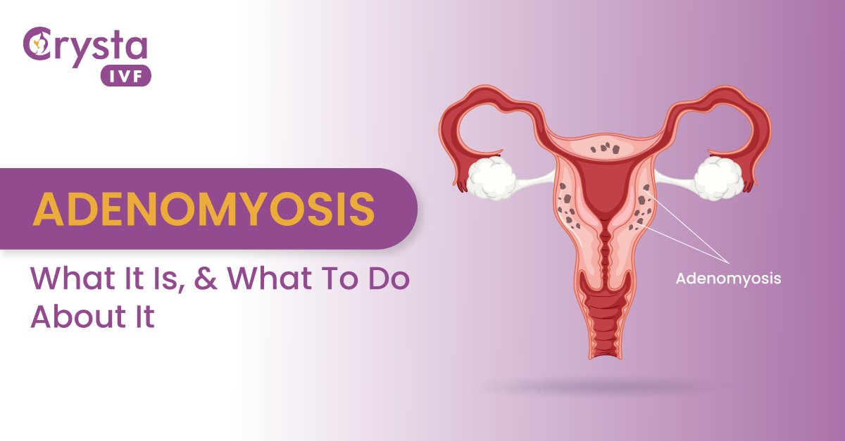 Adenomyosis Meaning: Symptoms, Causes, and Treatment